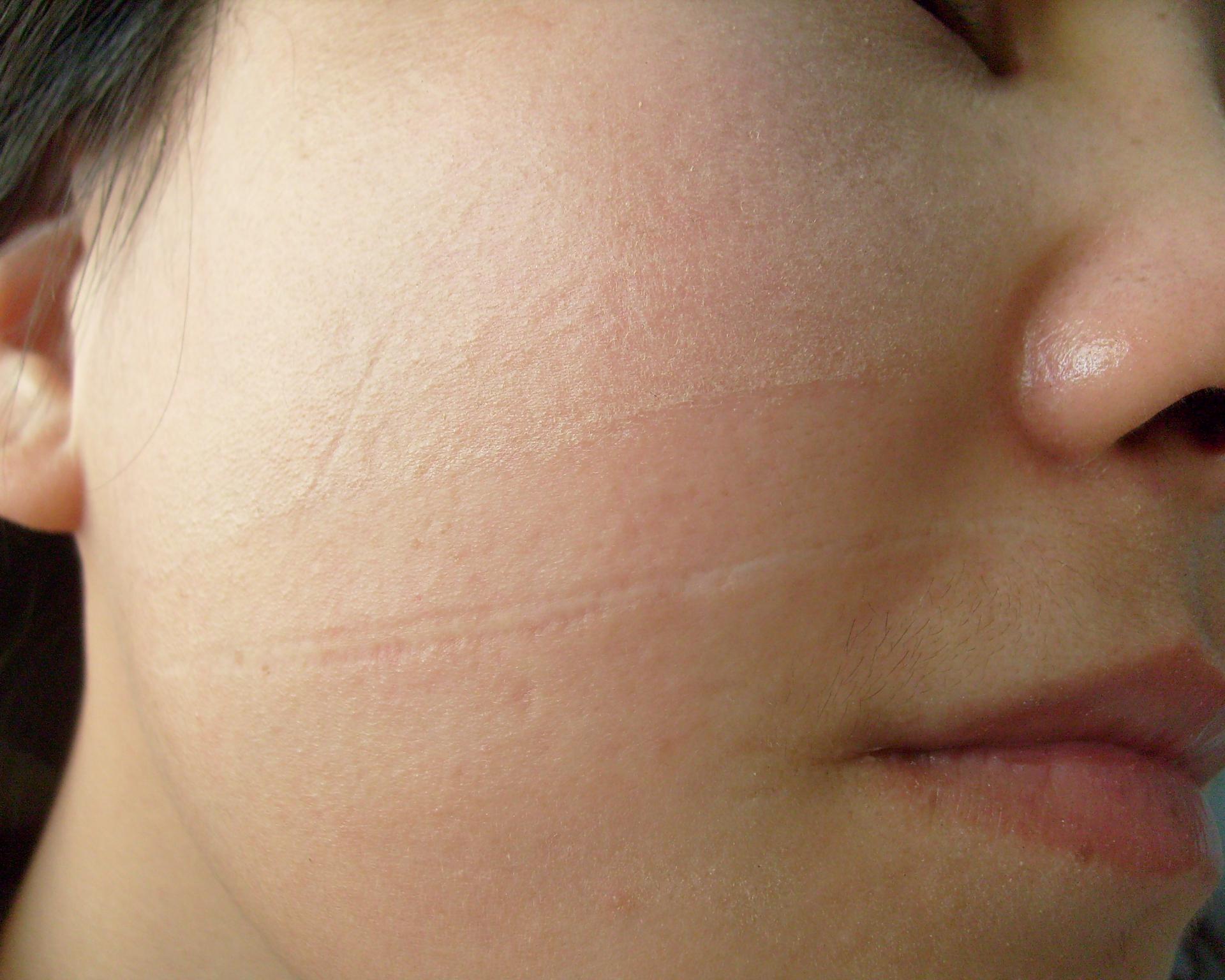 脸颊小时候利器划伤留下来的凹陷疤痕能修复吗?
