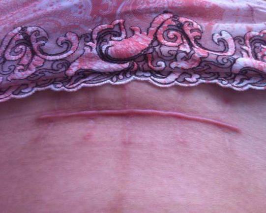 剖腹产一年多了,凸出,疼痒明显,能治吗?