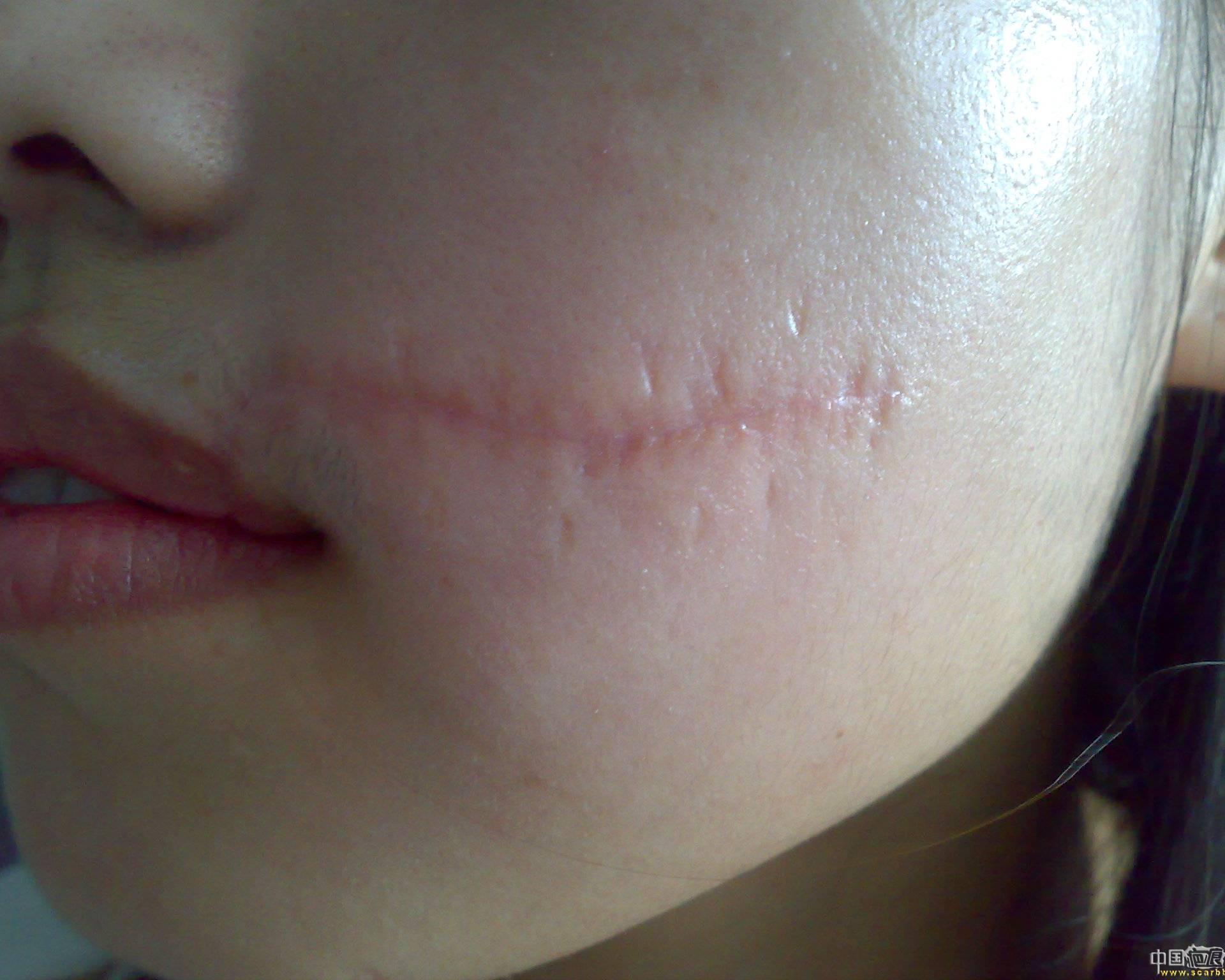 女儿去年被狗咬的疤痕能弄掉吗?是美容手术吗?